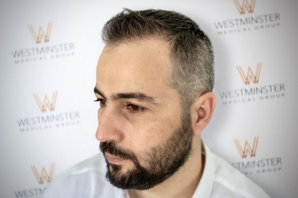 FUE-Hair-Transplant-UK-Westminster-Medical-Group-London-After2-2
