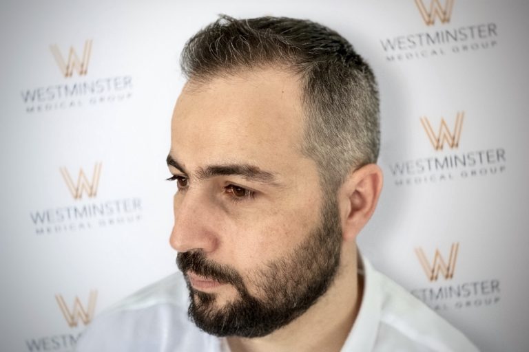 FUE-Hair-Transplant-UK-Westminster-Medical-Group-London-After2-2